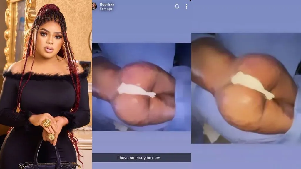 “I pray all my bruises clear” – Bobrisky Hope for Quick Recovery After Successful BBL Surgery (Video)